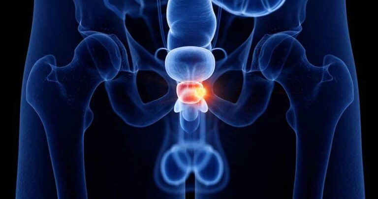 Tumore-alla-prostata-e-qualita-di-vita-nei-trattamenti