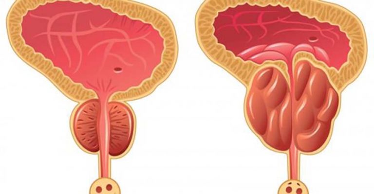 iperplasia prostatica benigna emicenter napoli