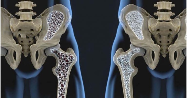 osteoporosi emicenter napoli