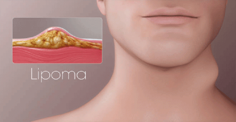 lipoma emicenter napoli