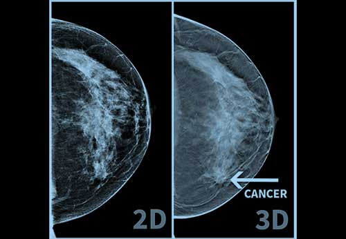 tomosintesi mammaria emicenter