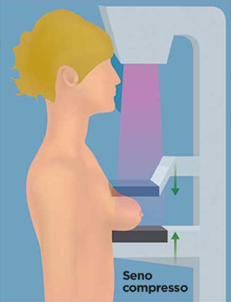 mammografia-risposte-professor-muto-infografica-1