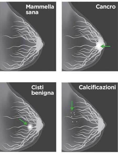 mammografia-risposte-professor-muto-infografica-2