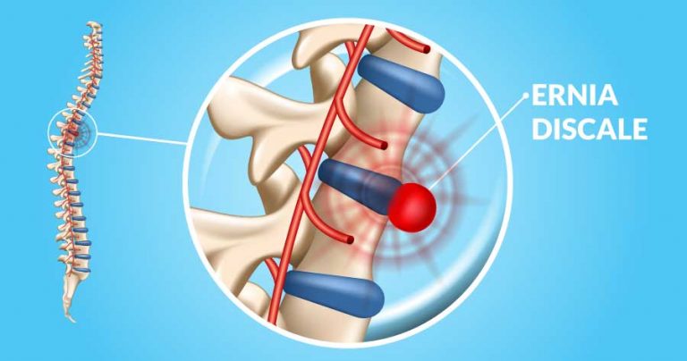 ernia-del-disco-diagnosi-e-trattamento-emicenter-napoli