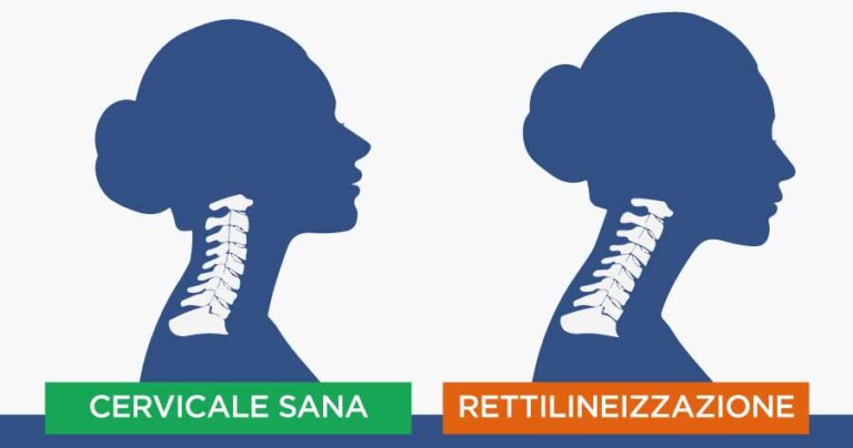rettilineizzazione-del-rachide-cervicale-emicenter-napoli