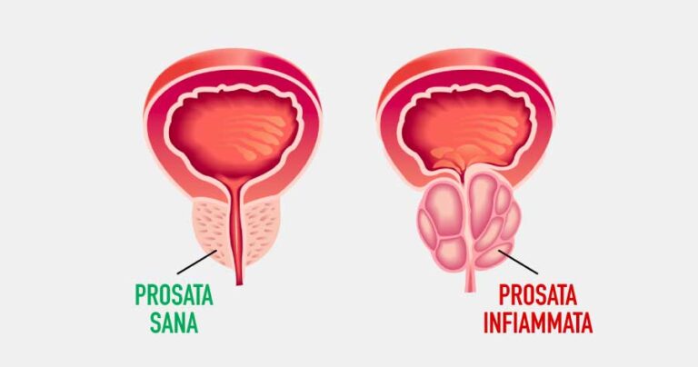 prostatite diagnosi e trattamento a napoli