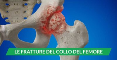 Le fratture del collo del femore